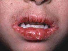 11 Cara Mengobati Bibir Bengkak Yang Jarang dilakukan - HaloSehat