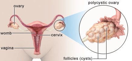 Polikistik Over Sendromu Ile Iliskilendirilen 7 Belirti Sagliga Bir Adim
