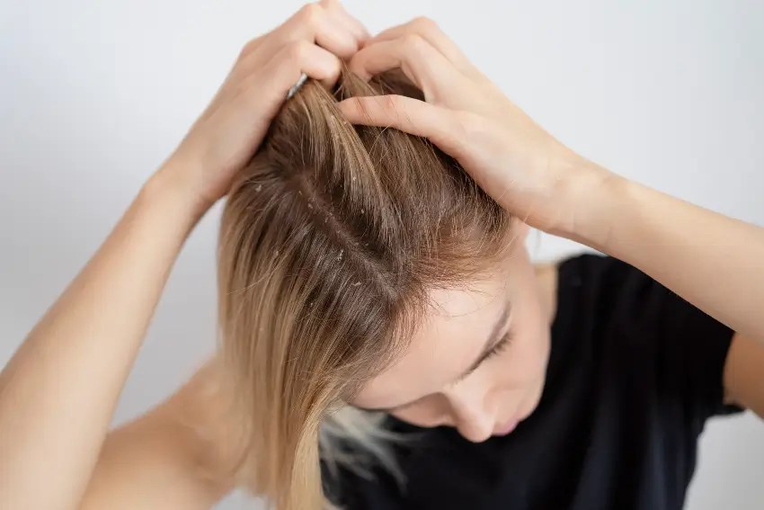 close-up-woman-with-dandruff-issues