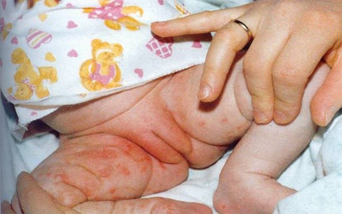 Сифилис — описание и лечение болезни. Можно ли вылечить сифилис навсегда и каковы последствия