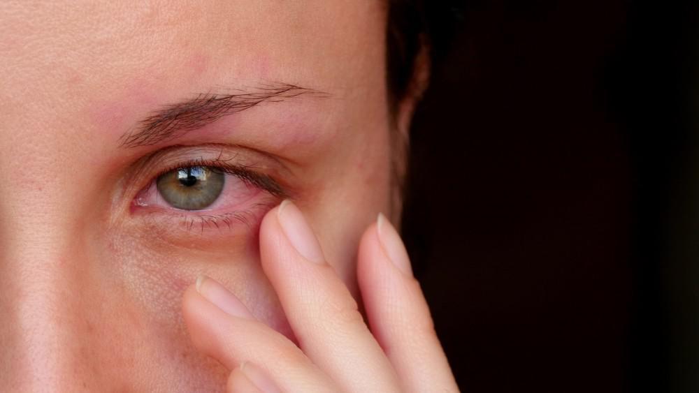 natural ways to treat eye stroke
