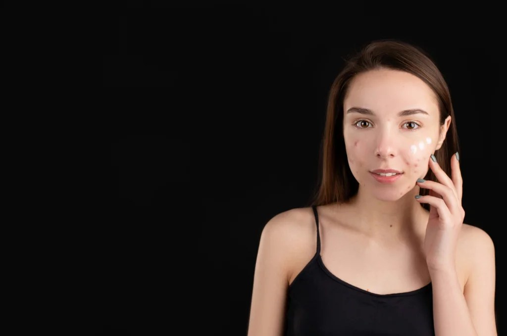 how to get rid from acne and pimples