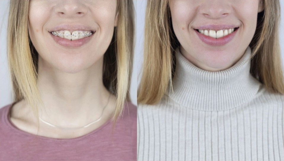 Jawline Before and After Braces: Face Shape