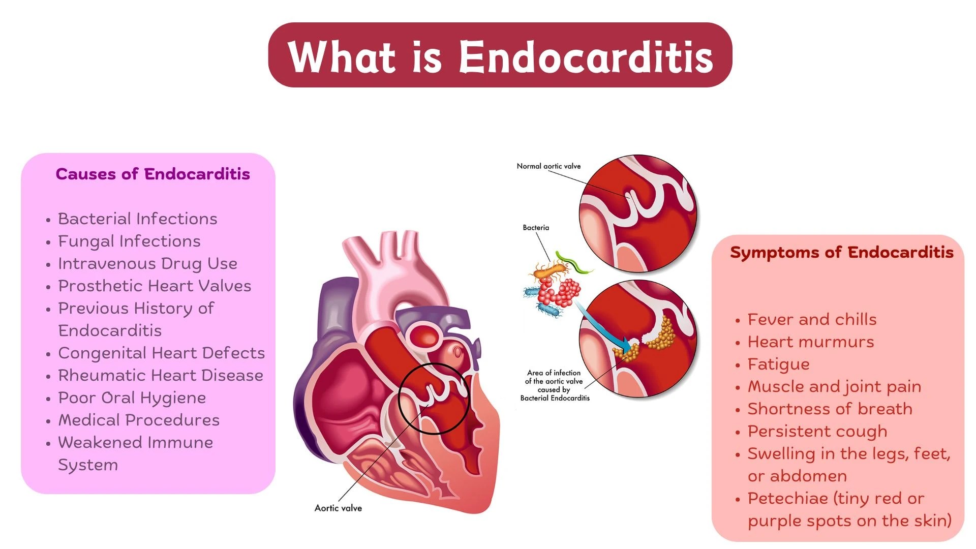 Endocarditis