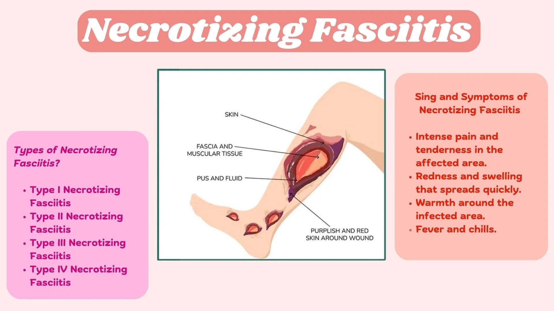 Necrotizing fasciitis