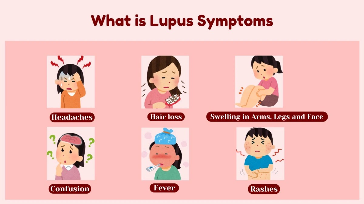 Close-up photo of a lupus face with a butterfly rash across her cheeks.
