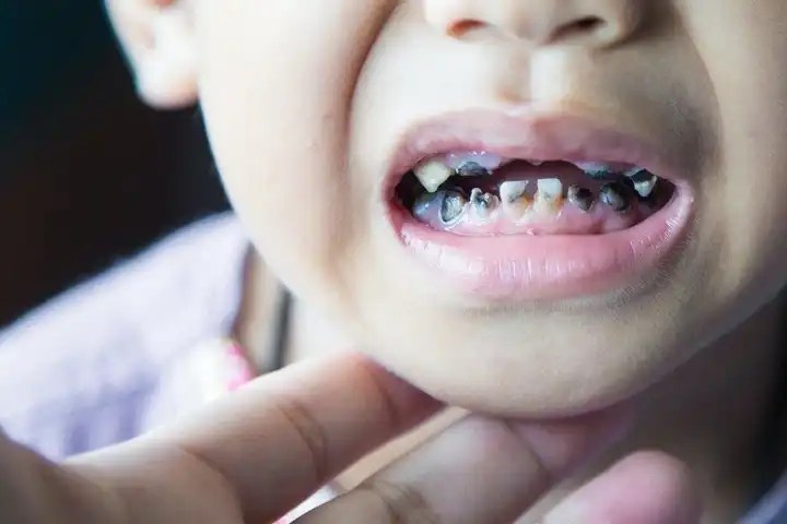 Baby Teeth Cavities