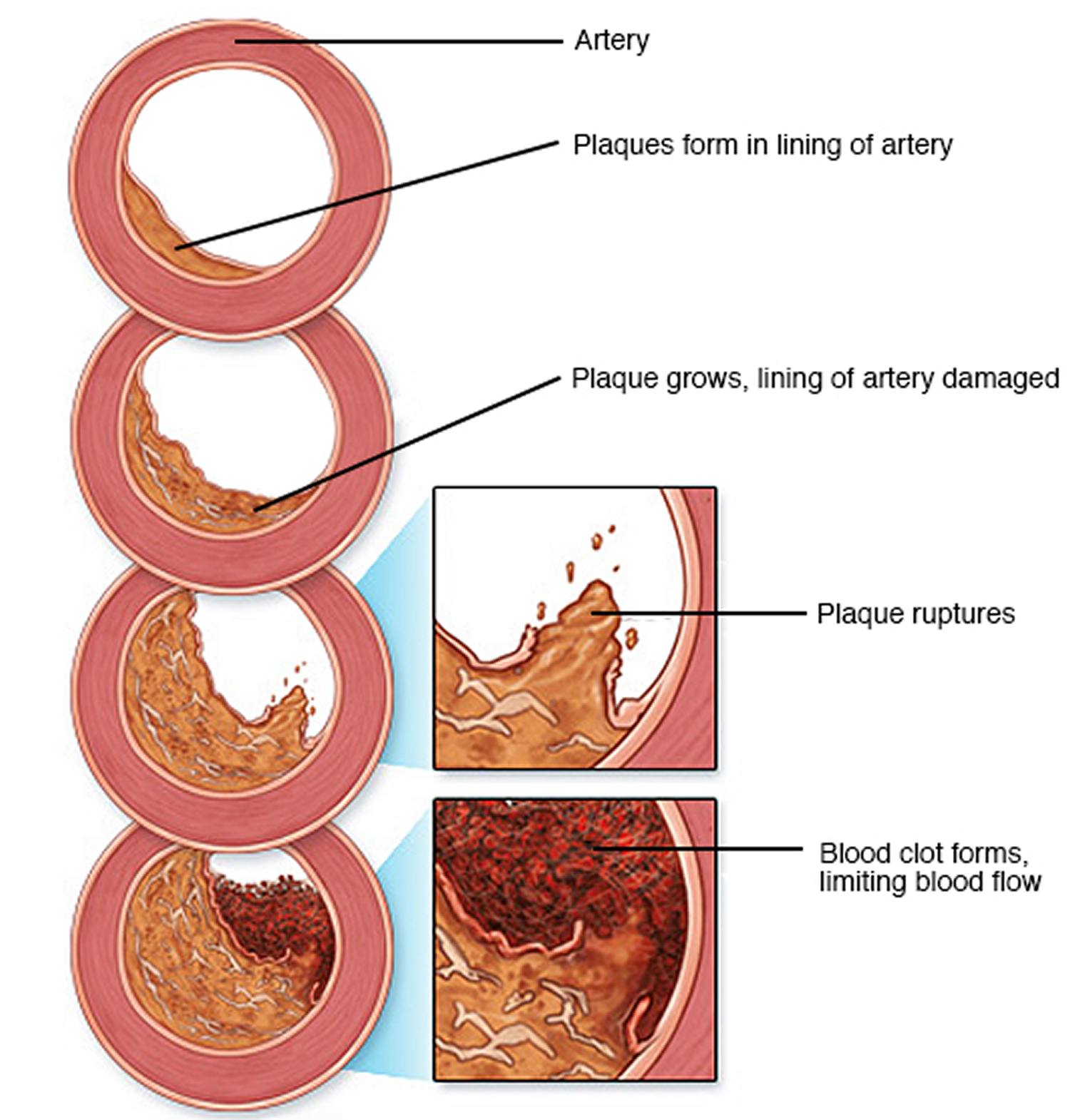 Arteriosclerosis | Radiology Reference Article | Radiopaedia.org Arteriosclerosis | Radiology Reference Article | Radiopaedia.org