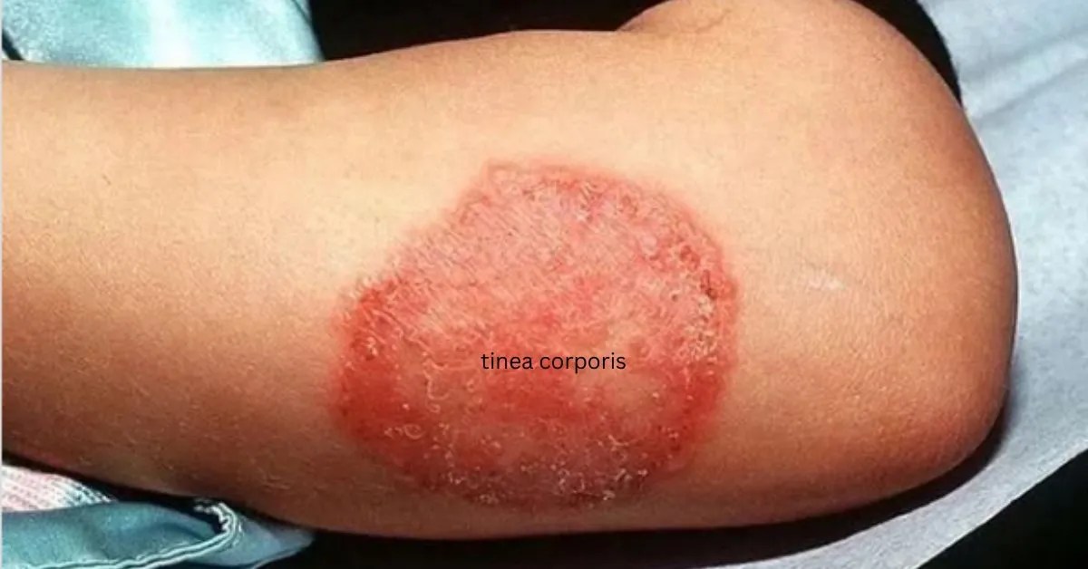 what is the best treatment for tinea corporis