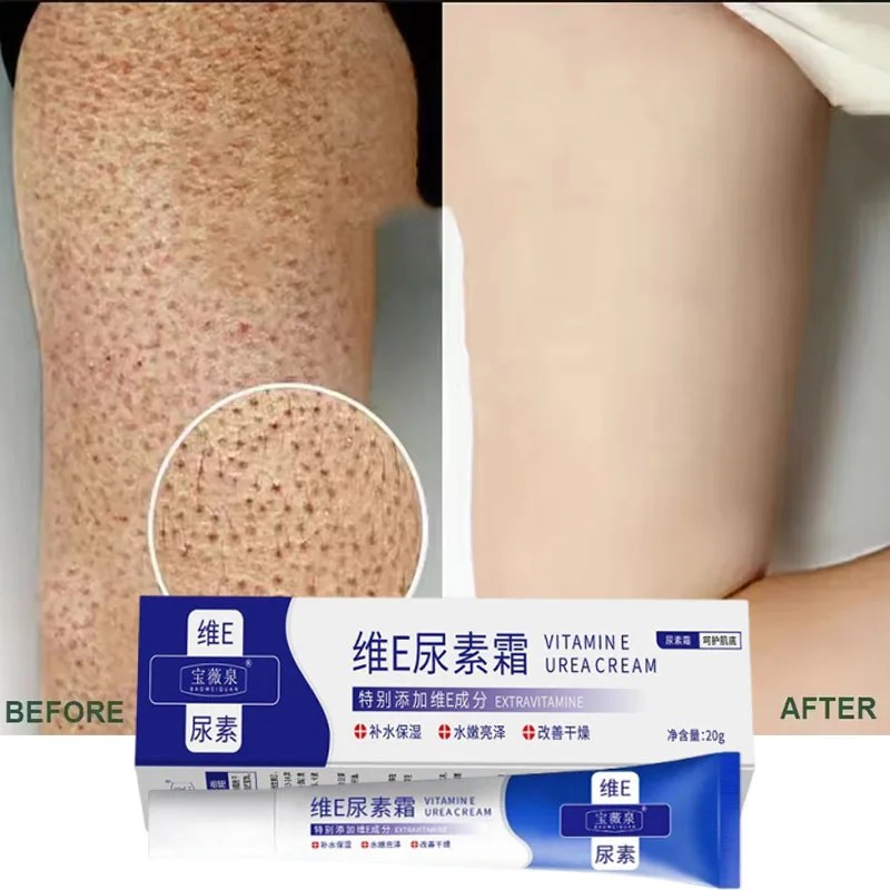Chicken Skin Removal Treatment Body Cream Remove Dead Skin Cell Shrink Pores Smooth Skin Tender Skin Moisturize Body Care Cream