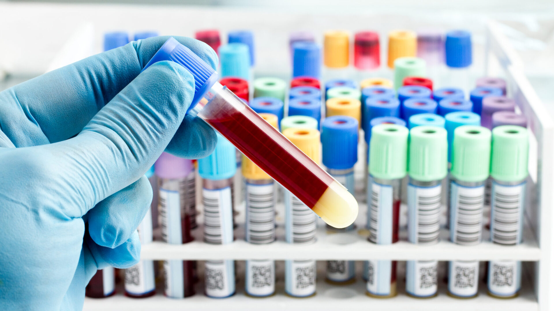 hand of a lab technician holding blood tube test and background a rack of color tubes with blood samples other patients / laboratory technician holding a blood tube test