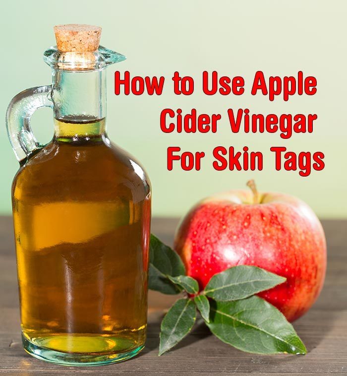 Learn how oil tank removal and oil tank installation works, and get t. How to Use Apple Cider Vinegar For Skin Tags - Healthy Focus
