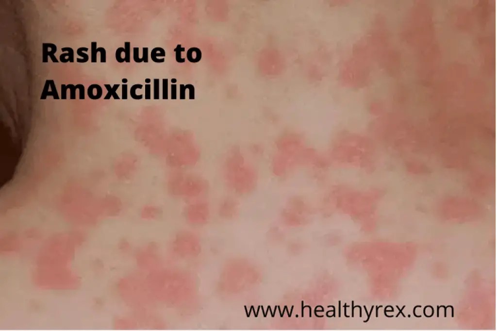 Can amoxicillin raise your blood sugar