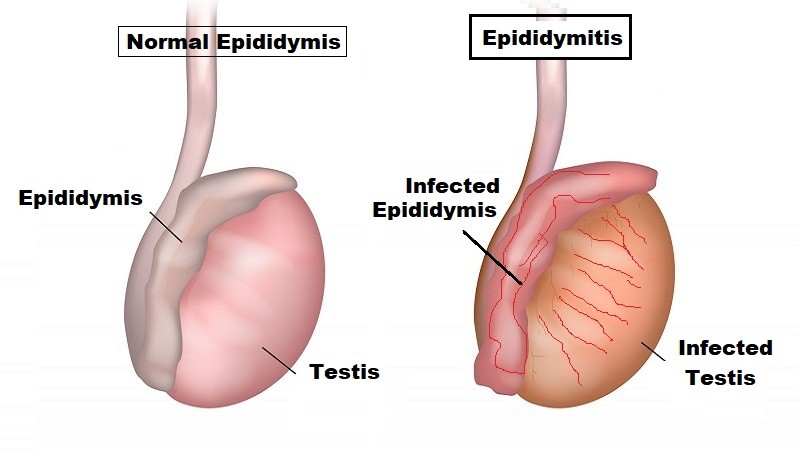 gabapentin for epididymitis