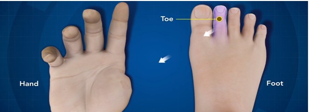 Toe transfer surgery – Explained by Dr. Leena Jain from Mumbai