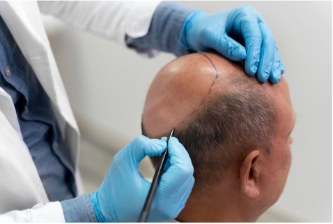 What You Should Know About FUE Hair Transplants – Dr. Harikiran Chekuri