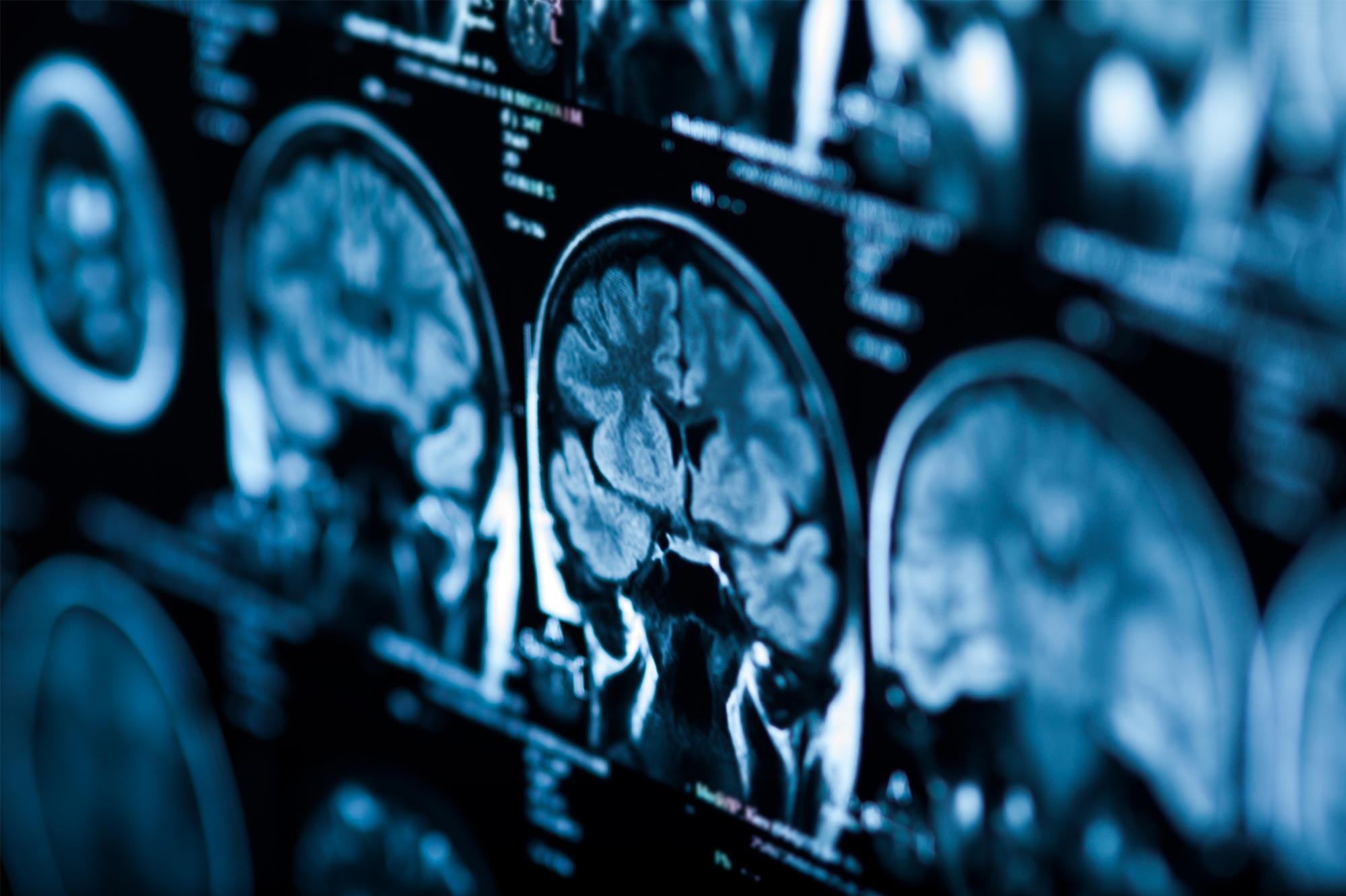 Brain X-Rays
