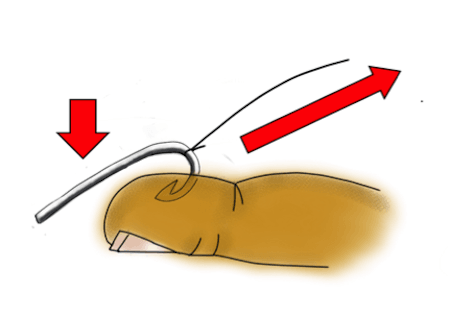 A fishhook stuck inside a finger