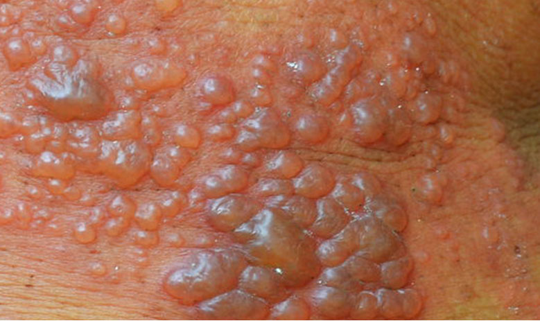 They can also form elsewhere on the face, especially around the chin and below the nose, or on the&nbsp;. Genital Herpes Treatment At Home Hsv 2 Online Treatment Herp Alert