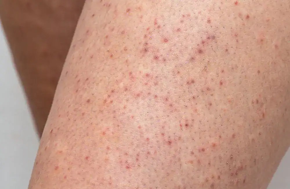 Keratosis Pilaris on skin