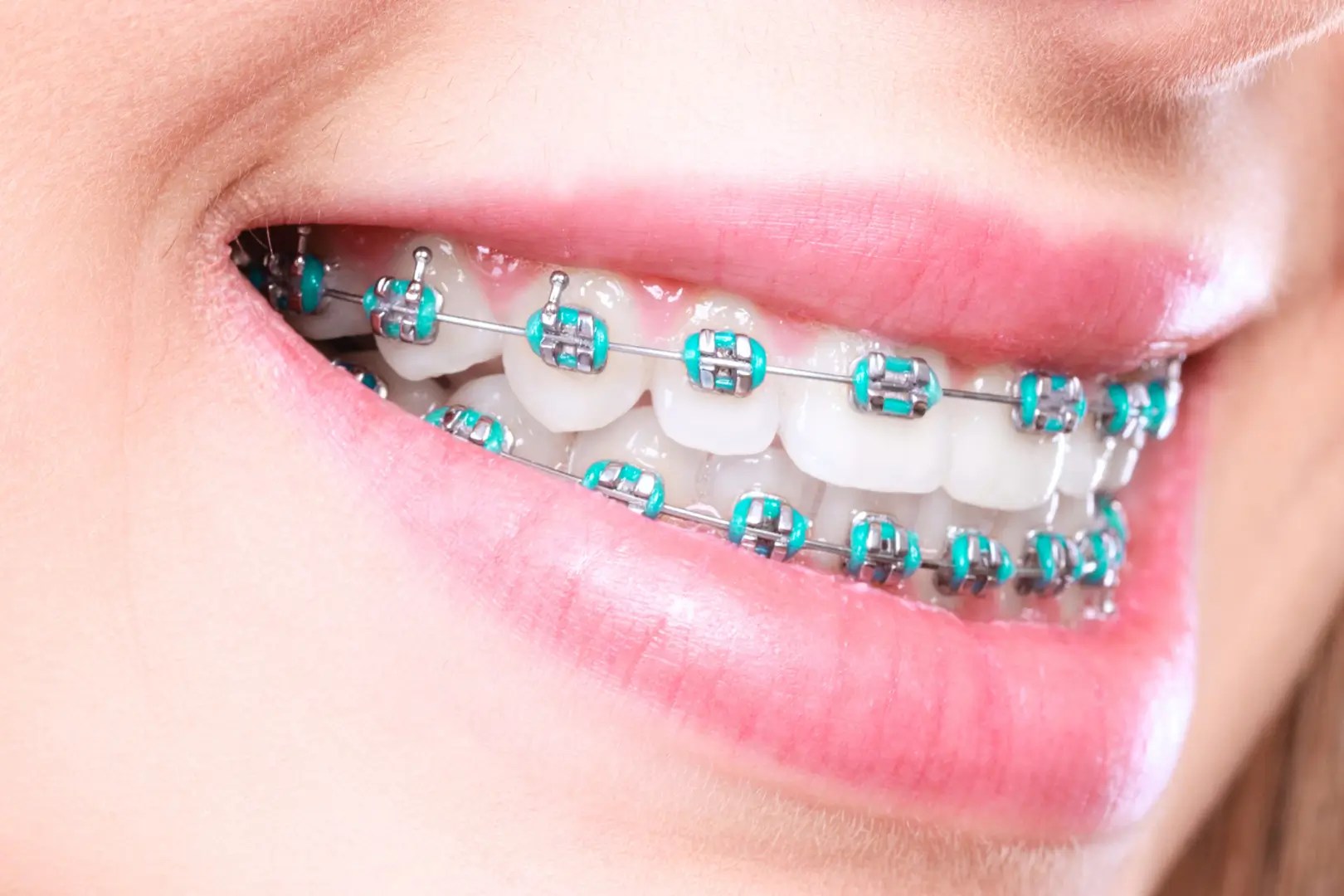 Braces