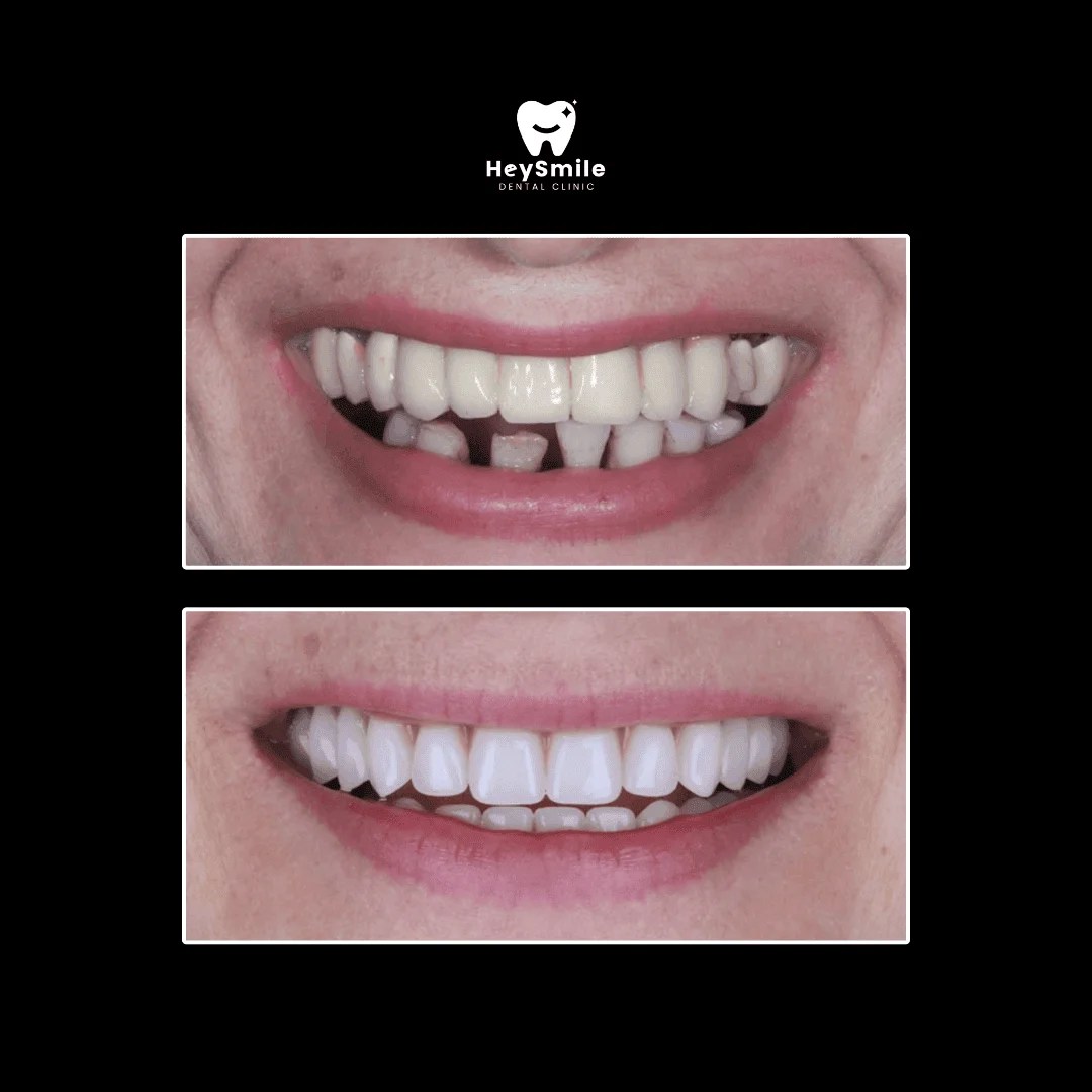 Multiple Missing Teeth (2)
