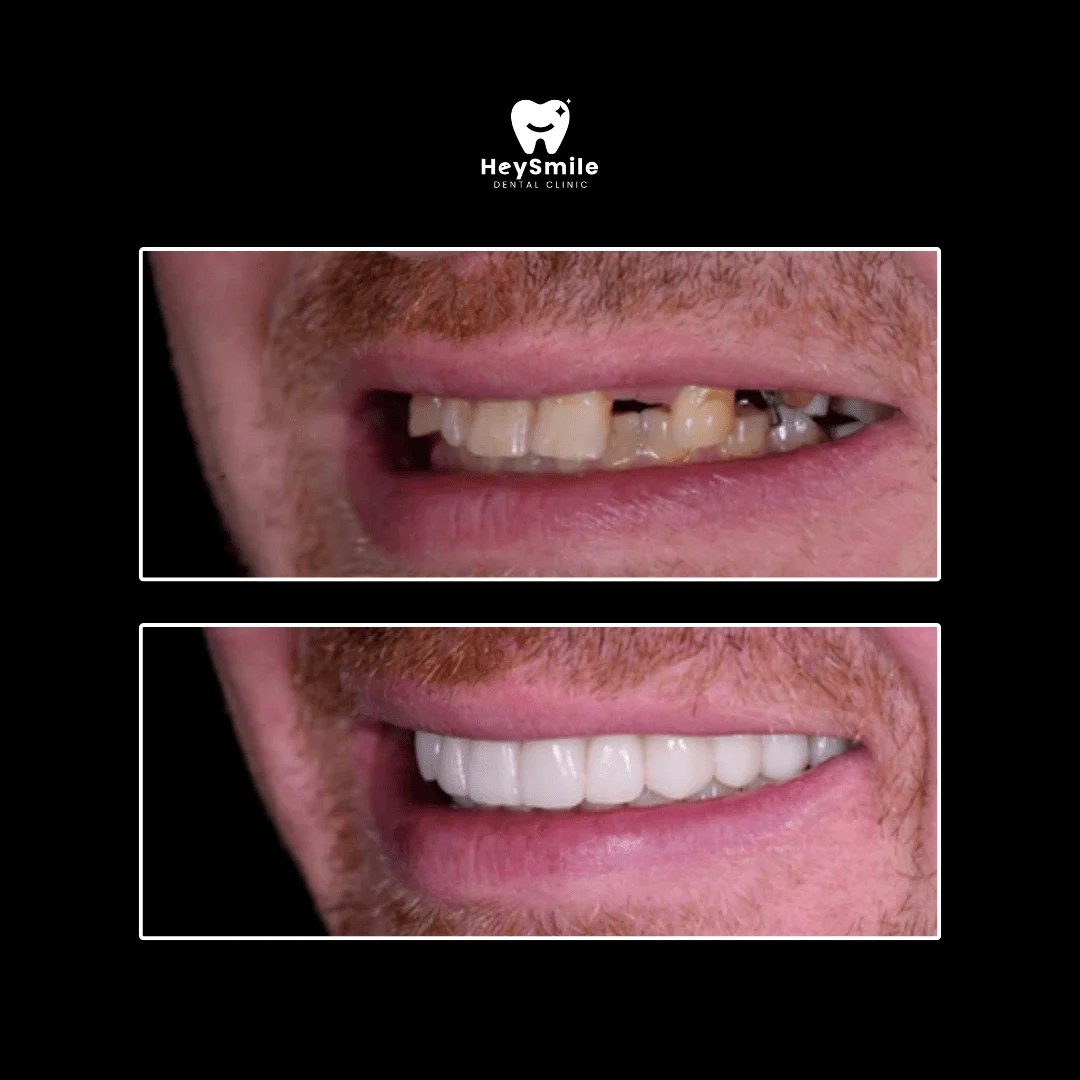 Multiple Missing Teeth (3)