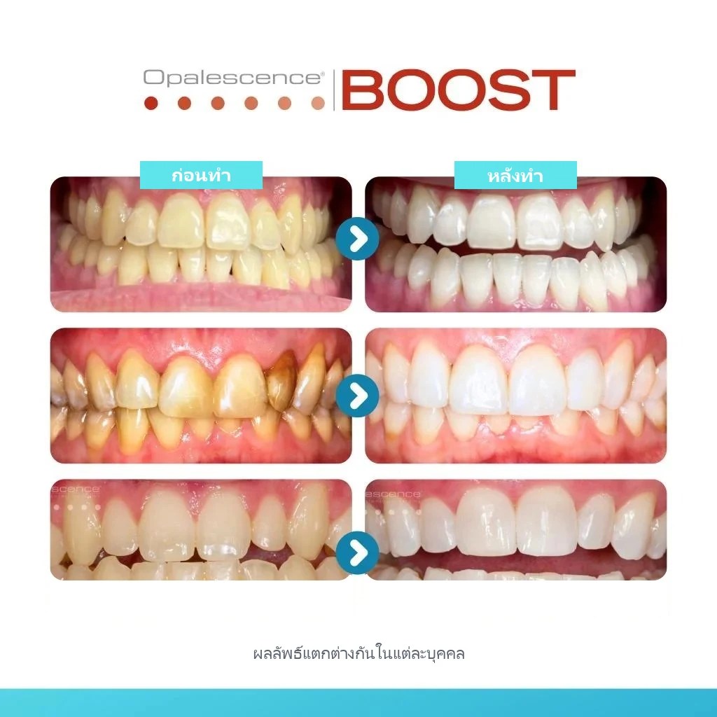 ตัวอย่างสีฟันก่อนทำและหลังทำฟอกสีฟันด้วย Opalescence Boost ผลลัพธ์แตกต่างกันในแต่ละบุคคล