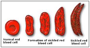 Types Of Geic Disorders Human Genome Project 11192015 73500 PM Company. Types Of Geic Disorders Human Genome Project Hemoglobin is a protein in red blood cells responsible for carrying oxygen throughout the body however when people produce Hemoglobin S it causes the red blood cells to distort into a crescent shape and become fragile this interrupts healthy blood flow and leads to anemia.