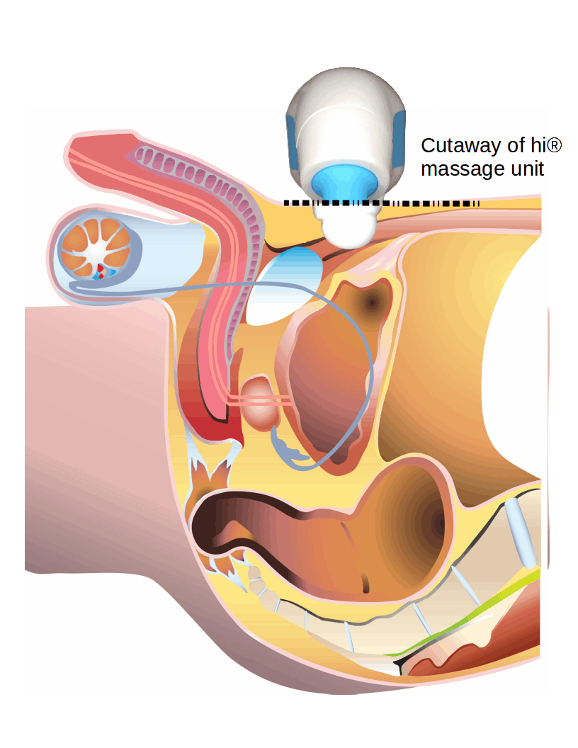 Animation of hi® male lower abdominal position