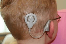 Imagen de la cabeza de un niño que está volteado y que tiene implante coclear, éste está detrás del oído y en su cabeza