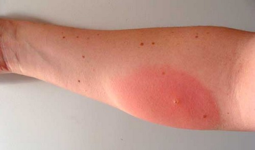 Укус Сильно Чешется И Опух. Укус Насекомых, Отек И Покраснение