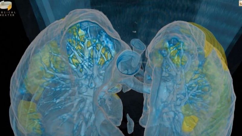 Медики показали, как коронавирус «убивает» легкие Медики показали, как коронавирус «убивает» легкие