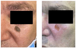 Cryotherapy versus hydrogen peroxide in the treatment of seborrheic keratosis