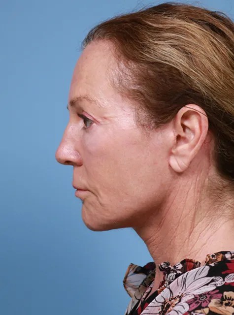 After Deep Plane Facelift