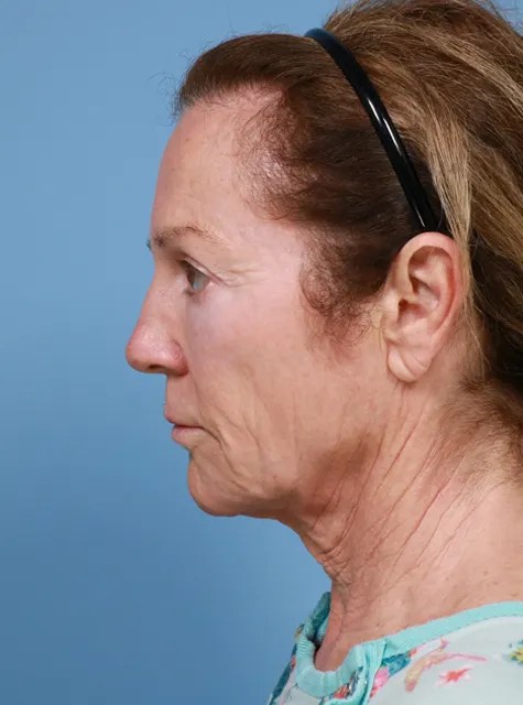 Before deep plane facelift and neck lift by Dr. Caroline Hudson in Chicago