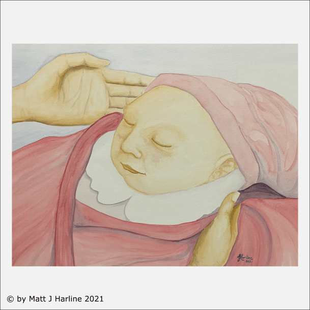 watercolor-Encephalocele-baby