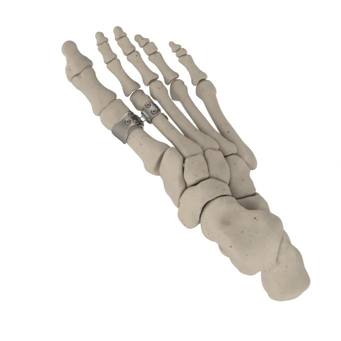 HyperFlex implant system render