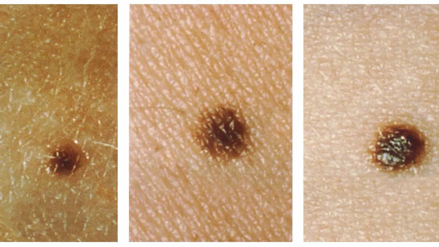 Cancerous Mole Vs Normal Mole - Best Nature Wallpapers in Mobile