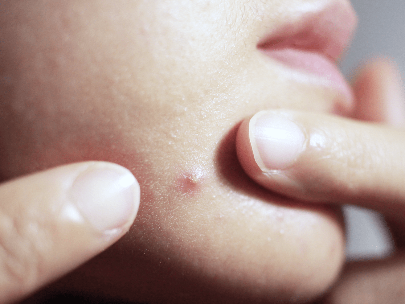 Lip bumps can come in many shapes and sizes with various associated symptoms. Here S What S Actually Inside Your Pimples