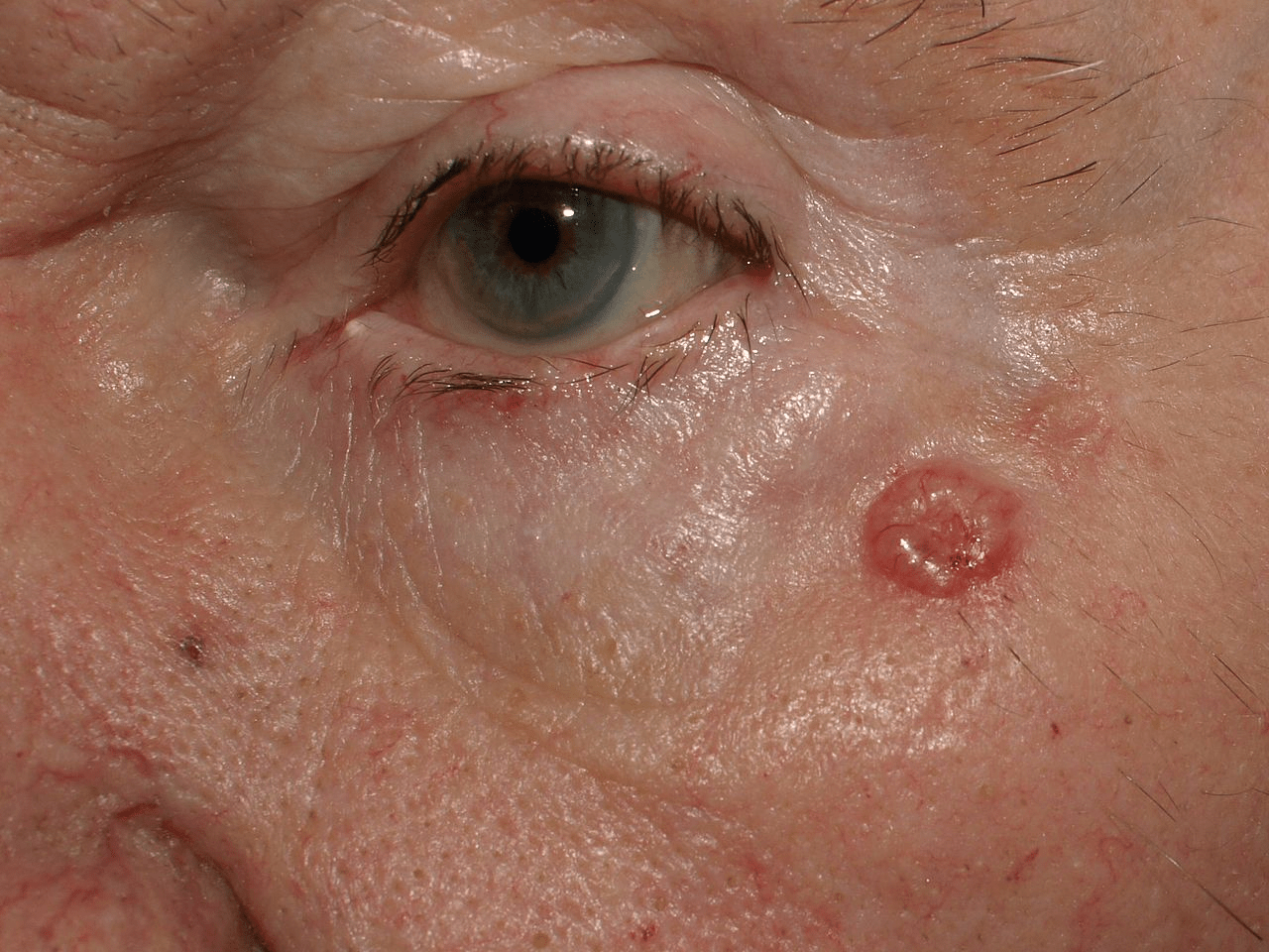 This leaflet contains information on how to spot the symptoms of skin cancer early and reduce your risk. Signs You Have Skin Cancer