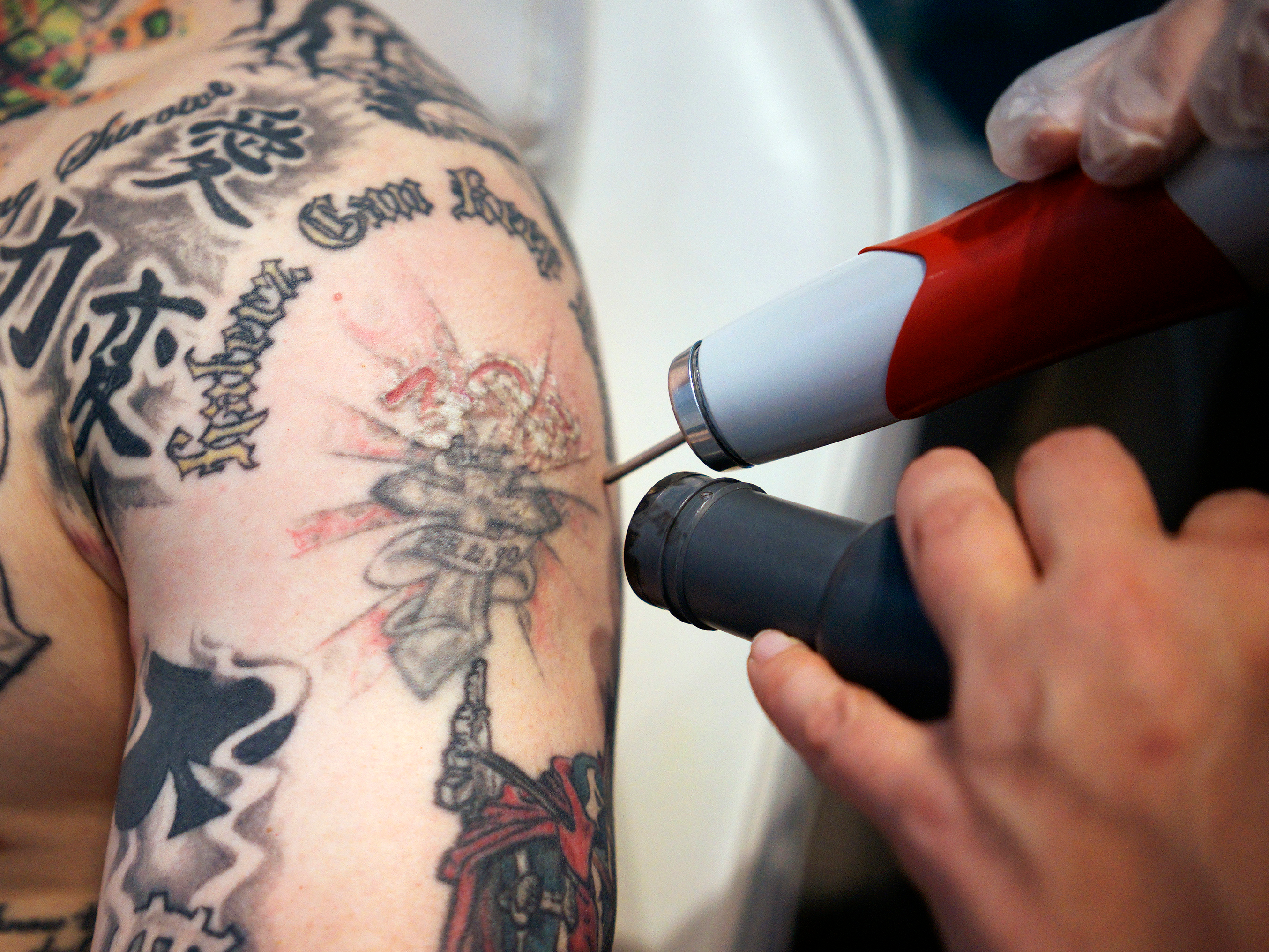 A Guide To Everything You Should Know About Tattoo Removal 525_x_700_jpg