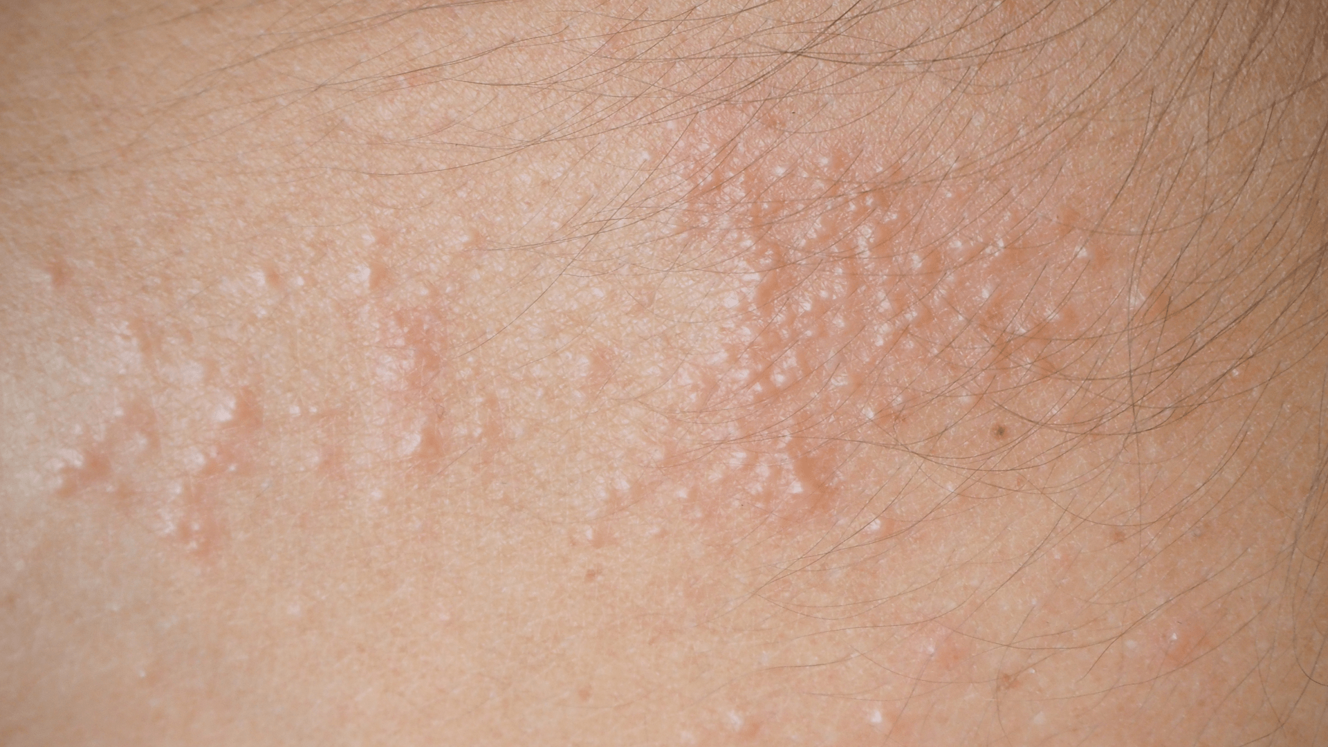 How to identify and treat heat rash in 6 steps