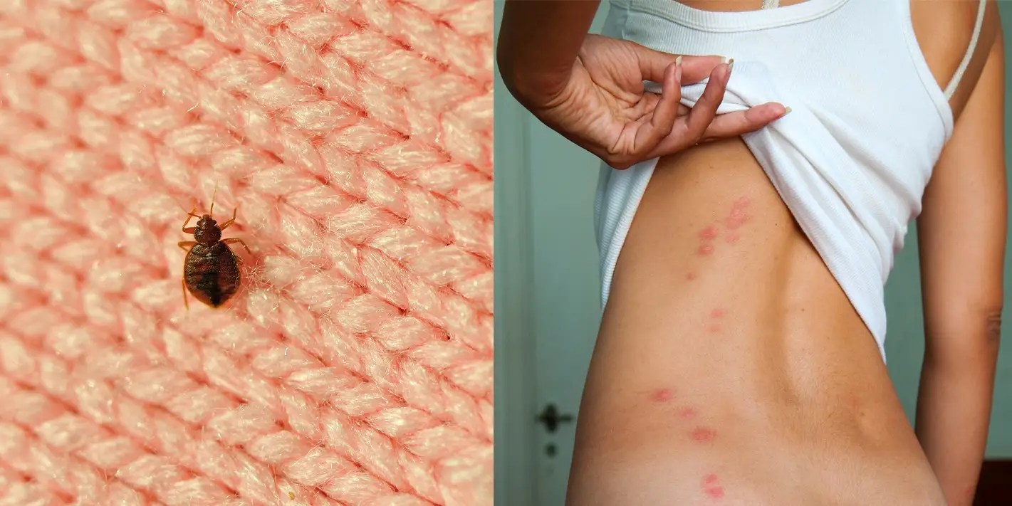 Bed bug bites can be itchy and unattractive, and they can sometimes get infected or even cause severe allergic reactions. Bug Bites: Pictures, Symptoms, Treatment, and Prevention