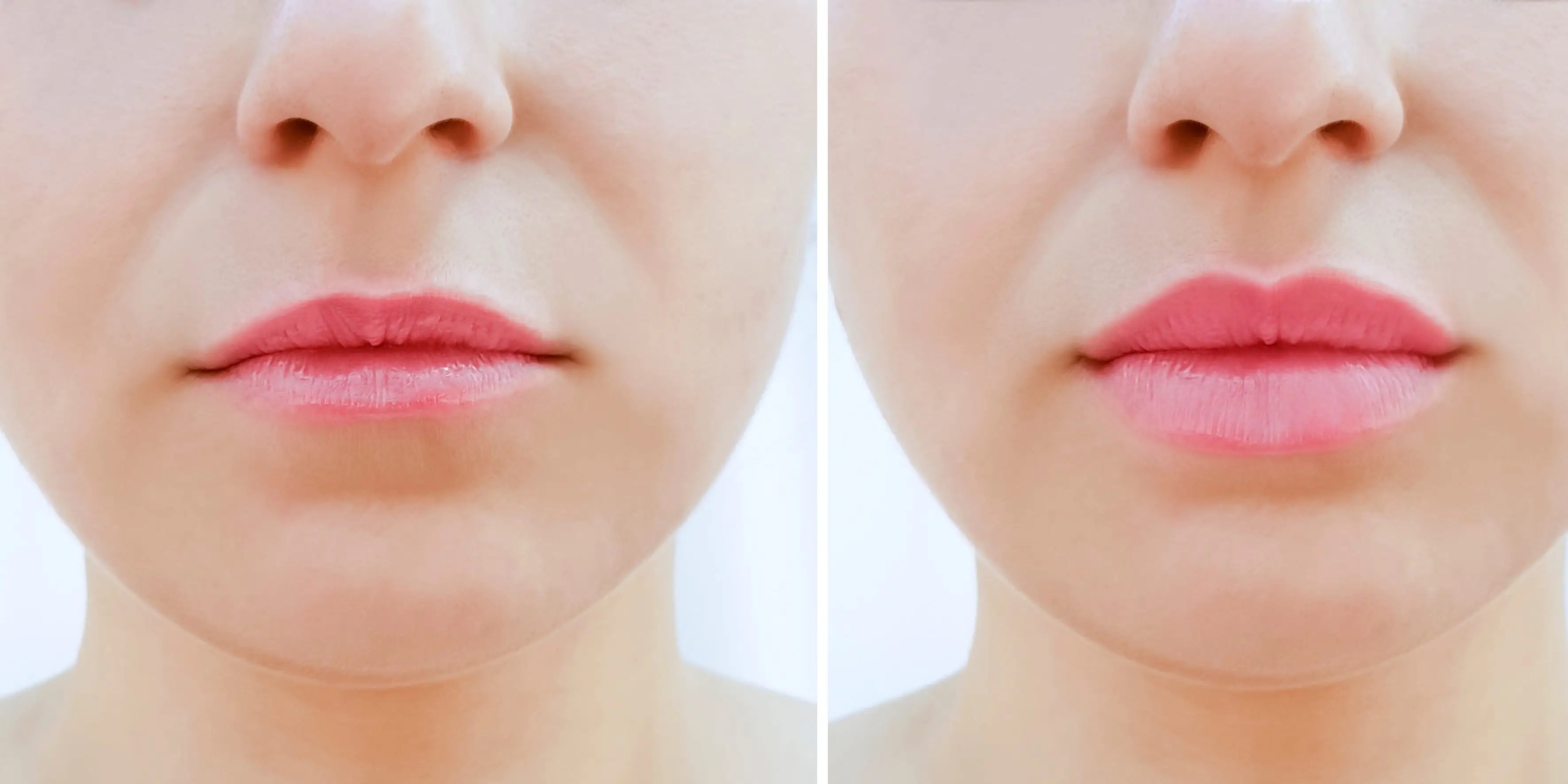 It is best to avoid drinking alcohol or smoking for 24 hours after getting lip fillers. Lip Injections How They Work What They Cost And What To Expect