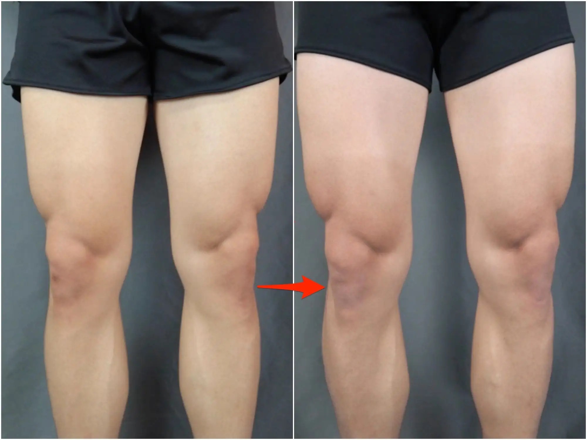 Check spelling or type a new query. A Youtuber Did 300 Squats A Day For 30 Days And His Quads Grew