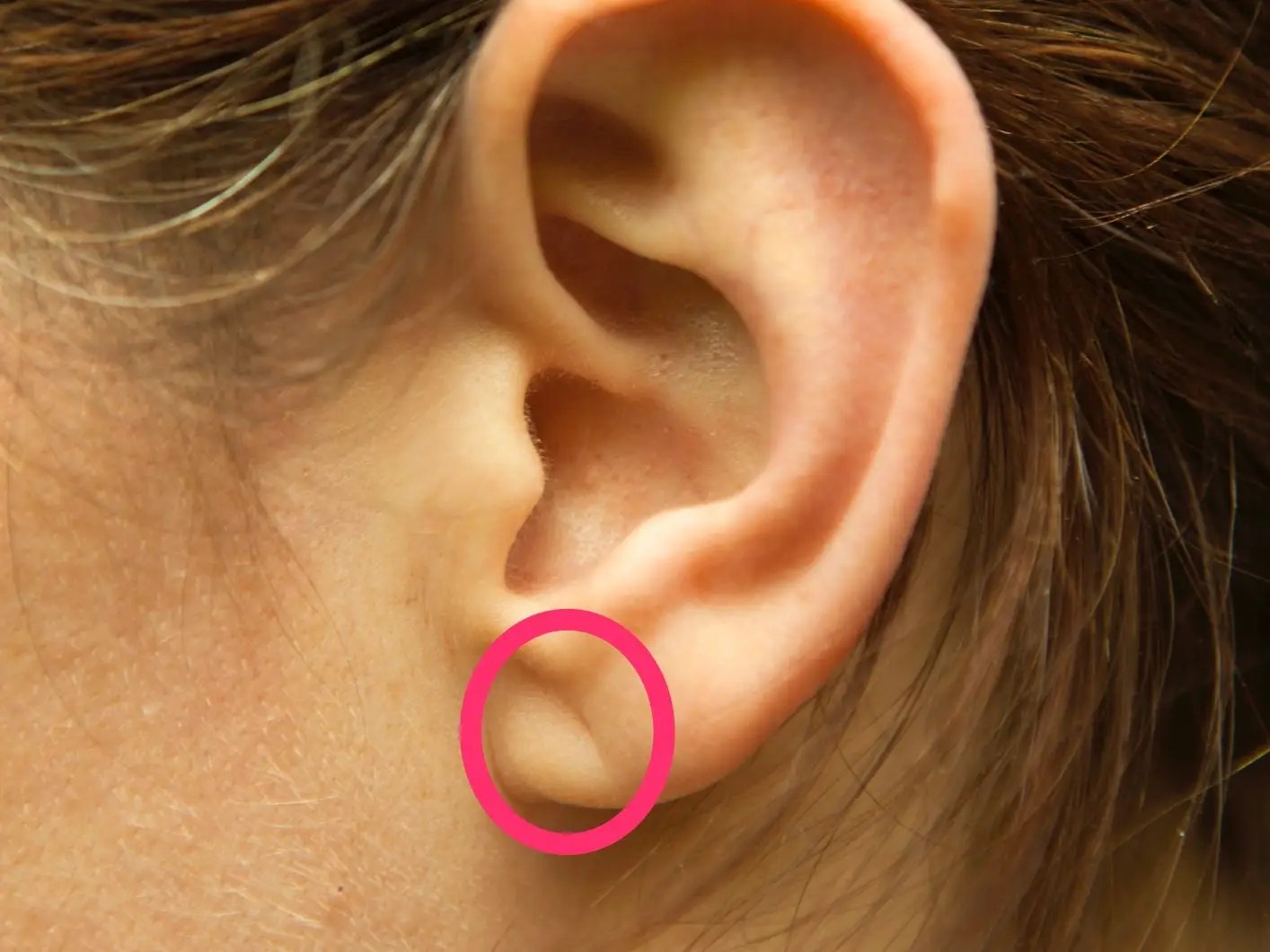 Earlobe crease: how it relates to coronary artery disease