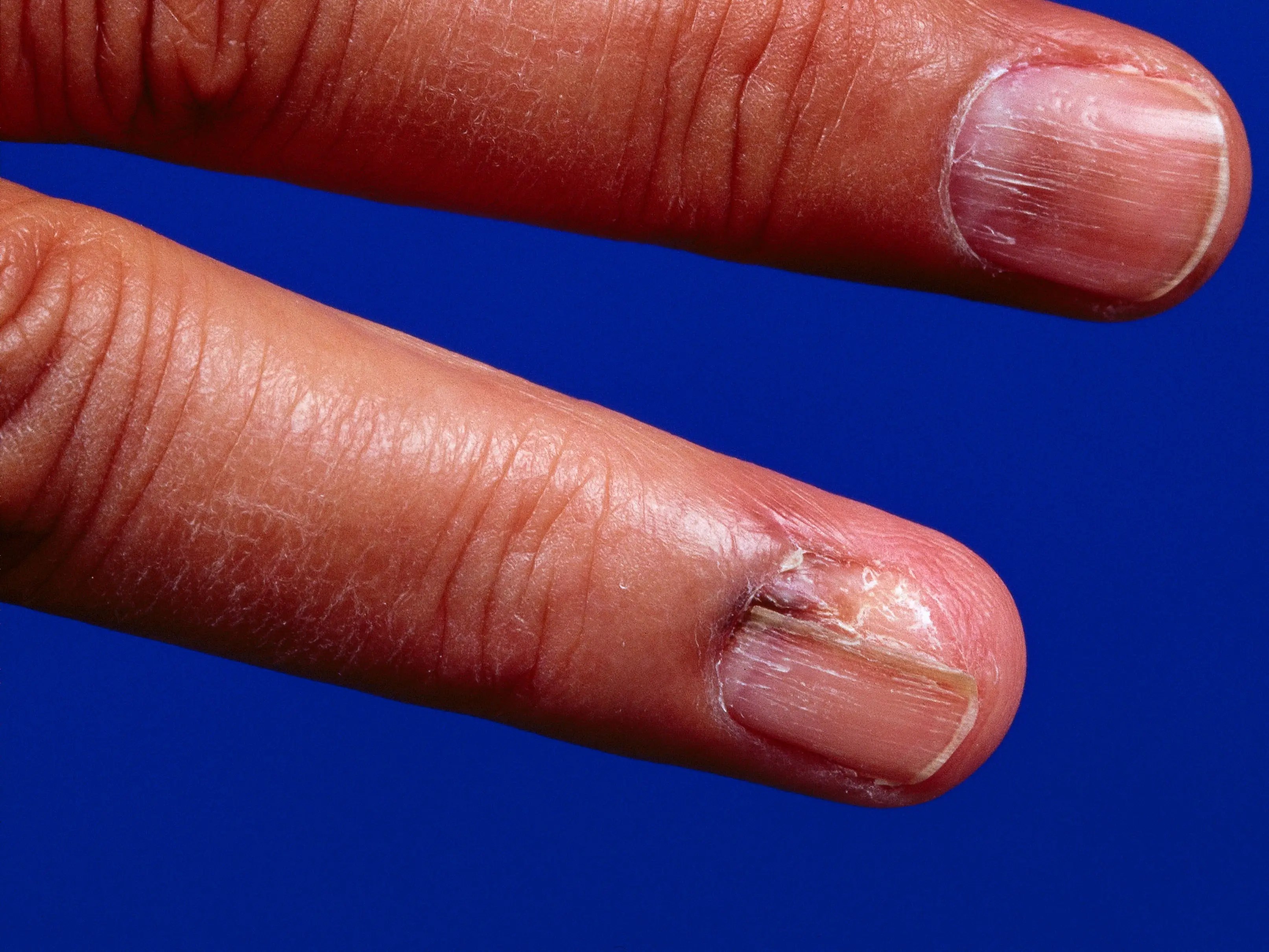 Woman with thin line on nail that looked like splinter had skin cancer