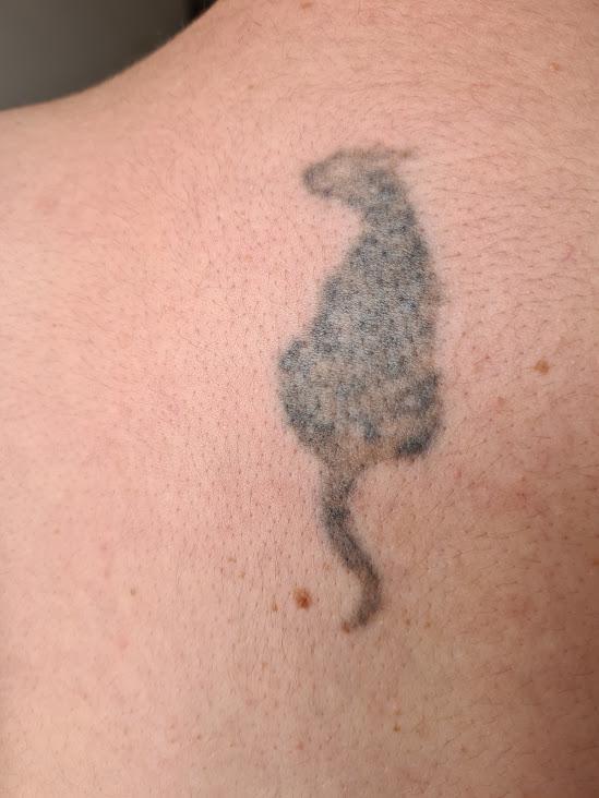 Neatcell tattoo removal?