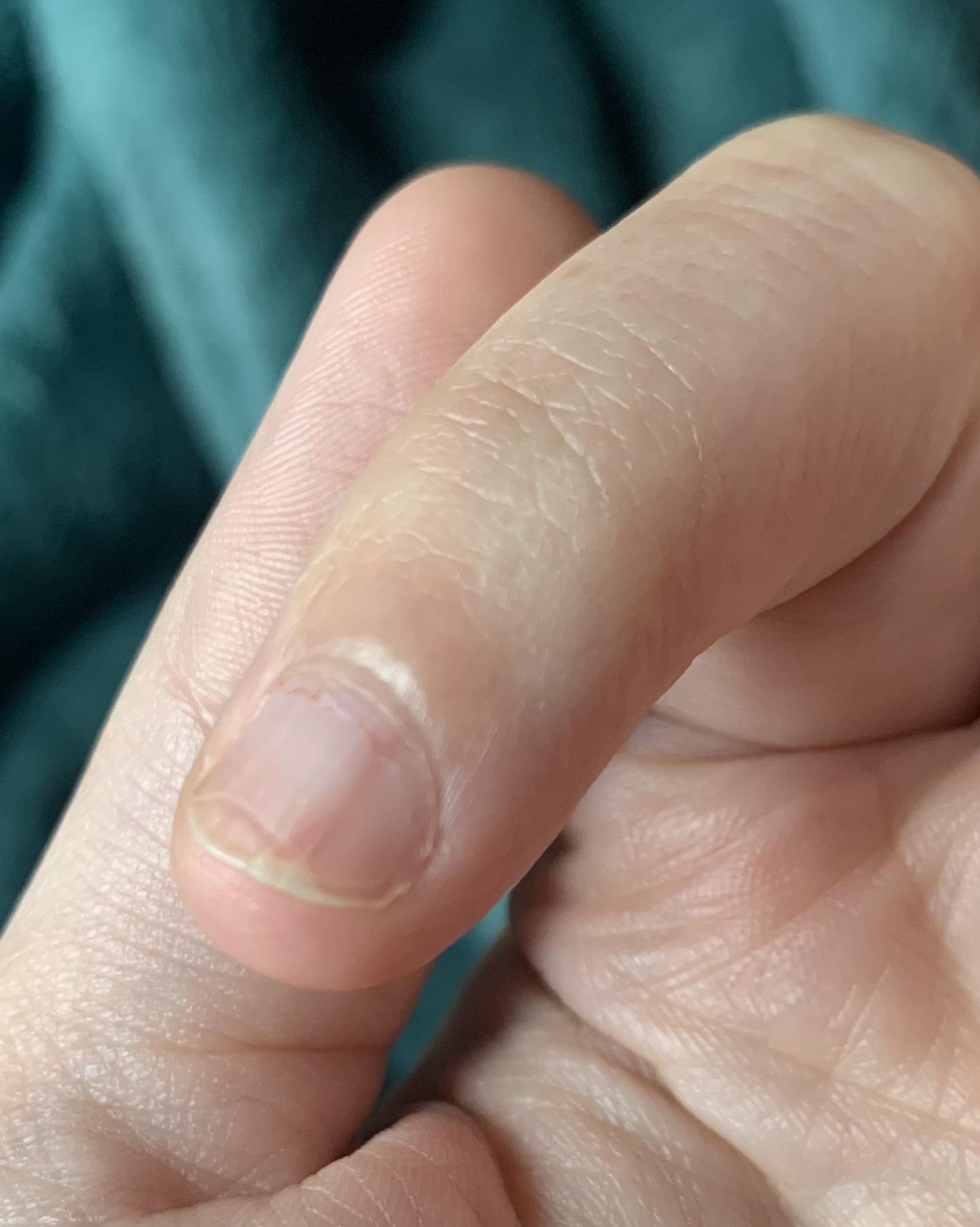 Pink/red line under finger nail? help!